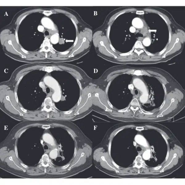 Lung Scans