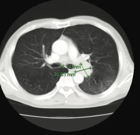 Lung Scans in Detail
