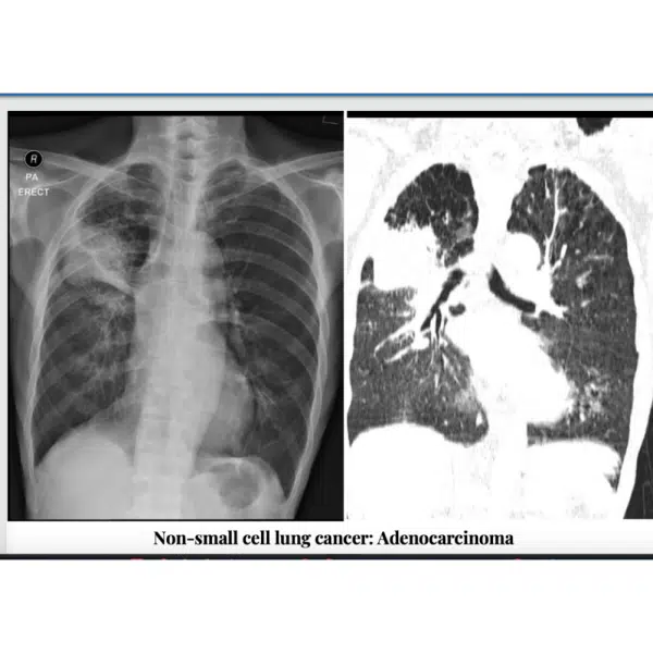Non-small cell lung cancer: Adenocarcinoma