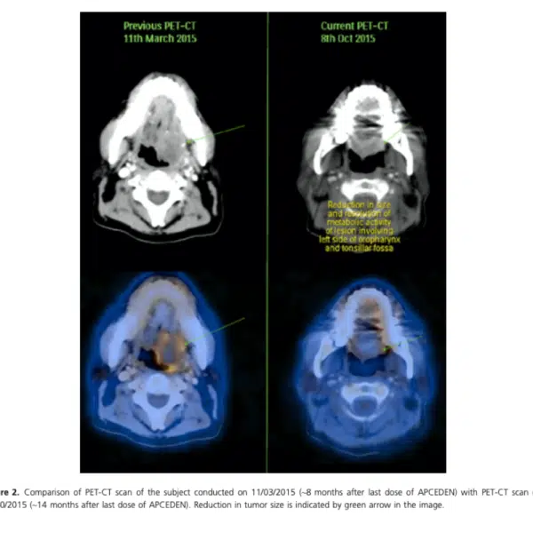 PET-CT Scan