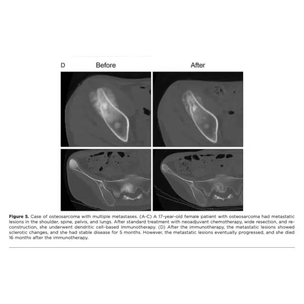Before and After Immunotherapy
