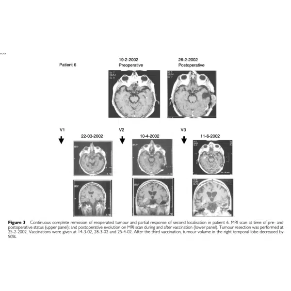 MRI Scan