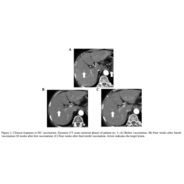 Clinical Response to DC Vaccination
