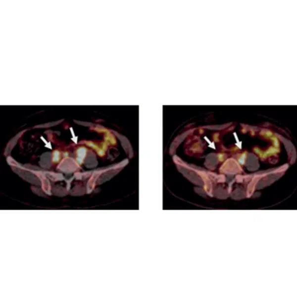 Tumour size before and after treatment