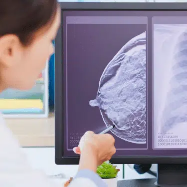 Breast cancer statistics