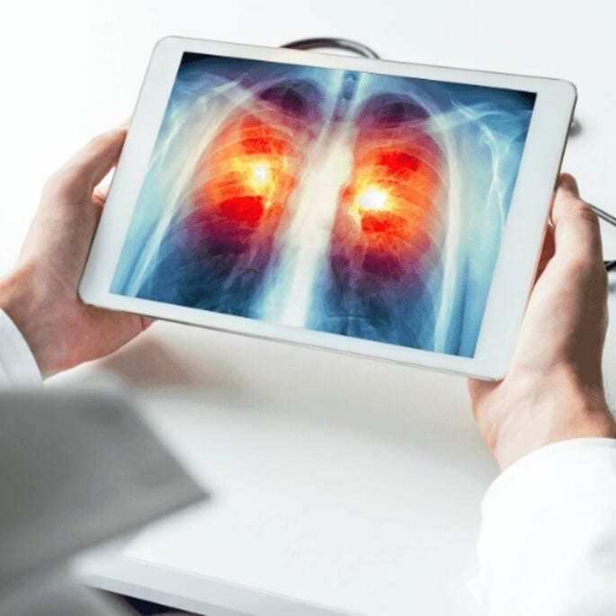 Promising Immunotherapy Approaches in Lung Cancer Therapy: Dendritic Cell Therapy