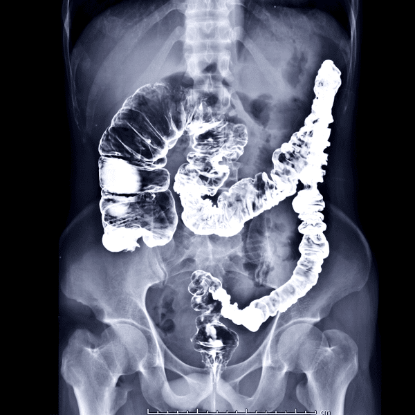 Lifestyle and Diet: A Colorectal Cancer Connection