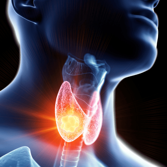 Addressing Thyroid Cancer